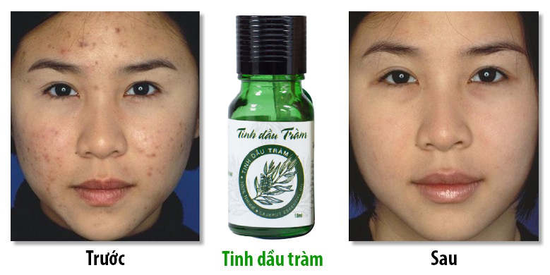 tri-mun-trung-ca-hieu-hieu-bang-tinh-dau-tram-nguyen-chat